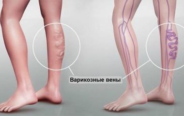 Варикозне розширення вен